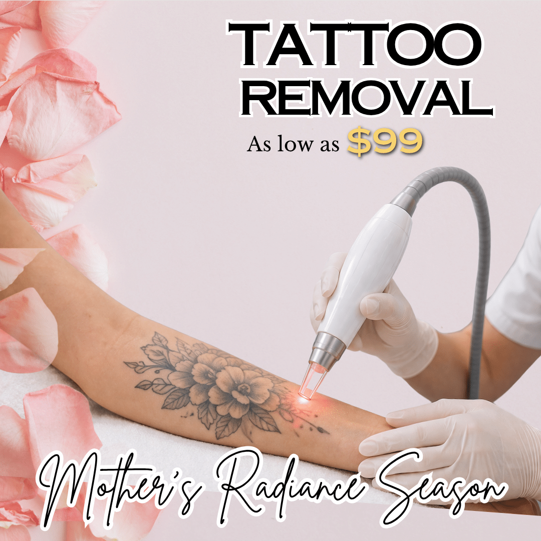 Tattoo Removal Tattoo Removal