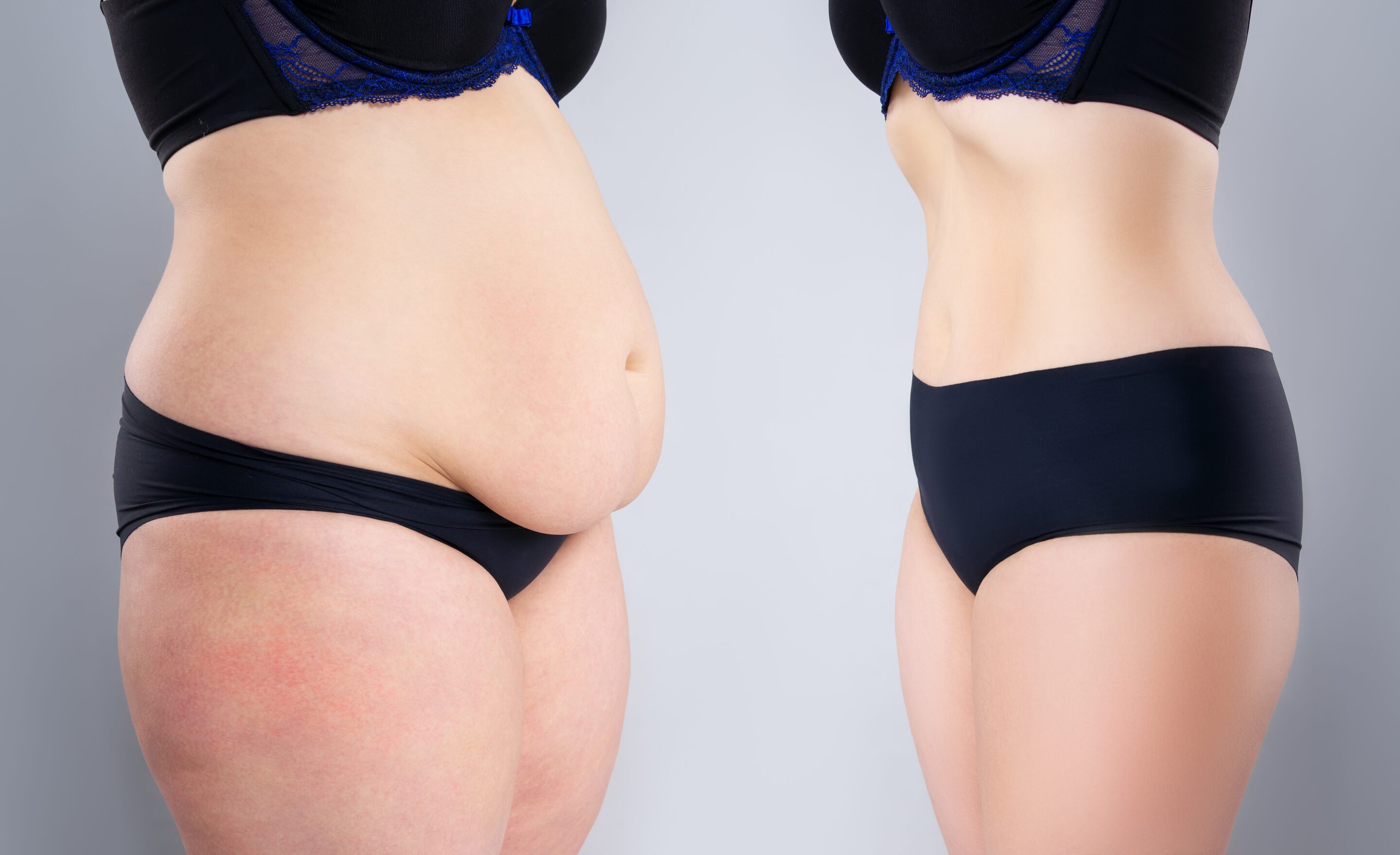 drainless tummy tuck recovery why more patients are choosing drainless techniques drainless tummy tuck recovery why more patients are choosing drainless techniques